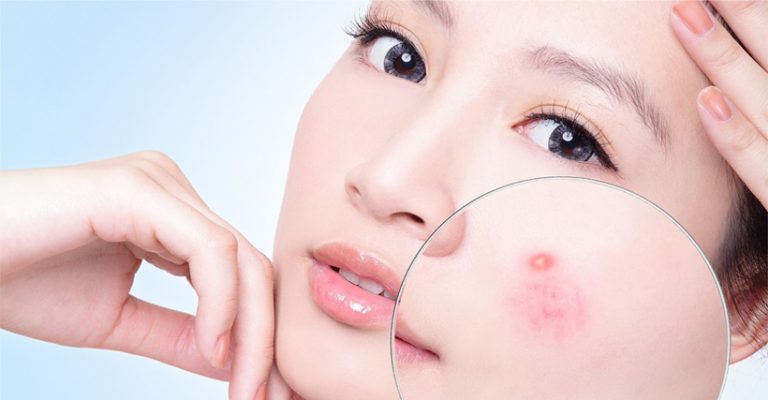 Chăm sóc da mụn: Những lưu ý quan trọng bạn không được bỏ qua