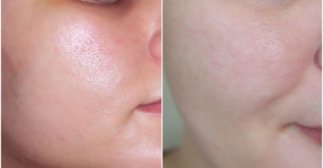 Điều trị lỗ chân lông to