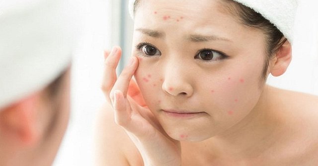 Trị mụn ở spa hay da liễu trả lời
