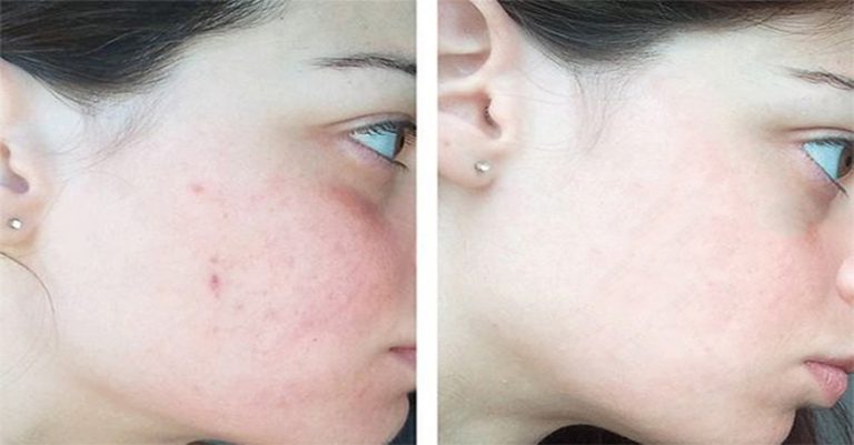 Công dụng làm trắng sáng da của Vitamin C, Niacinamide và cách sử dụng đúng