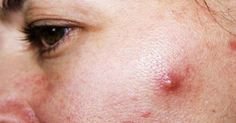 5 nguyên tắc chăm sóc da mụn – Hiệu quả cho mọi loại da và ngăn mụn trở lại