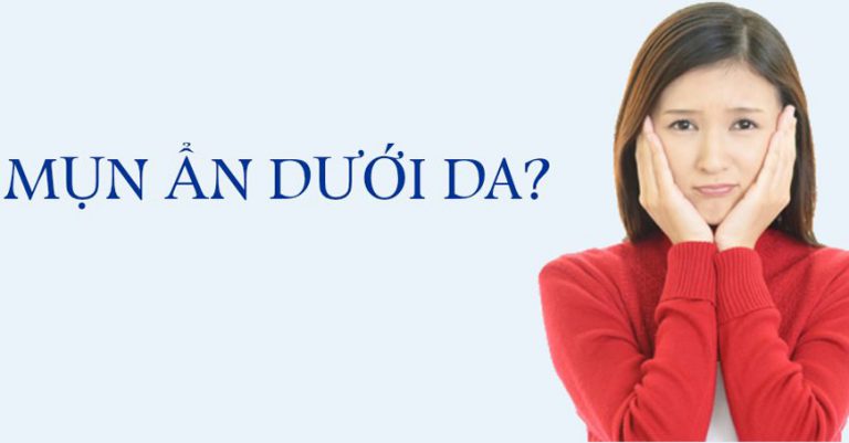 Lưu ý khi trị mụn ẩn tại nhà và bí quyết làm mờ thâm mụn nhanh chóng