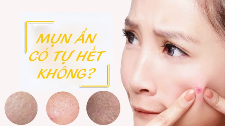 Những điều cần biết để điều trị mụn ẩn dứt điểm và an toàn