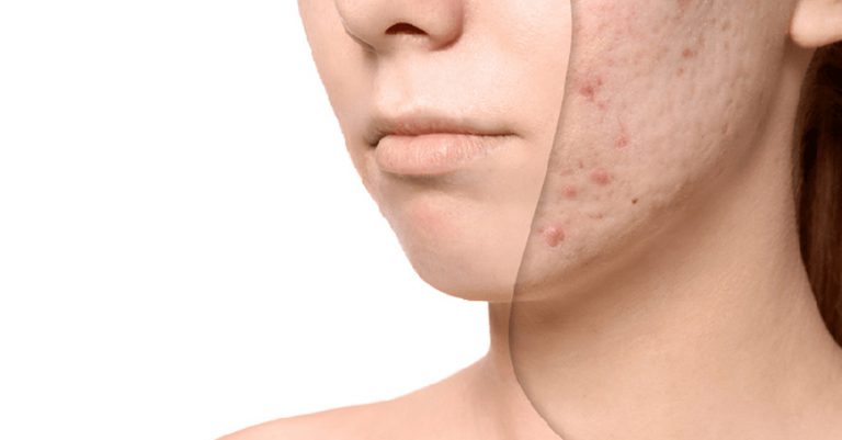 Sẹo sau mụn. Nguyên nhân và cách điều trị