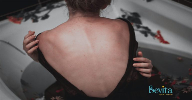 Đánh bay mụn lưng với 5 bước đơn giản, an toàn