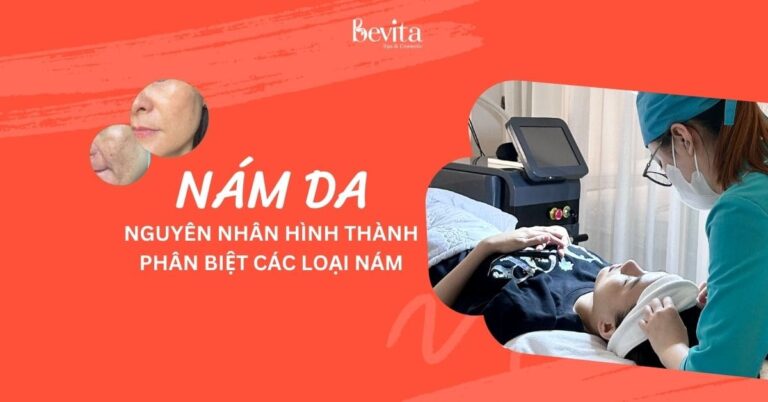 Nám da là gì? Nguyên nhân hình thành, phân biệt các loại nám? Tại sao nám ở phụ nữ nhiều hơn nam giới?