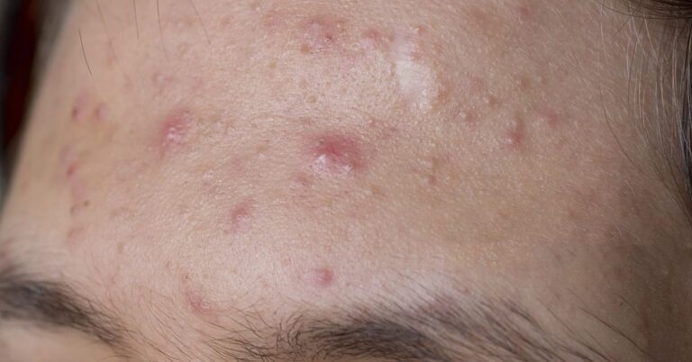 Lấy nhân mụn có hết mụn không? Khi nào nên lấy nhân mụn?