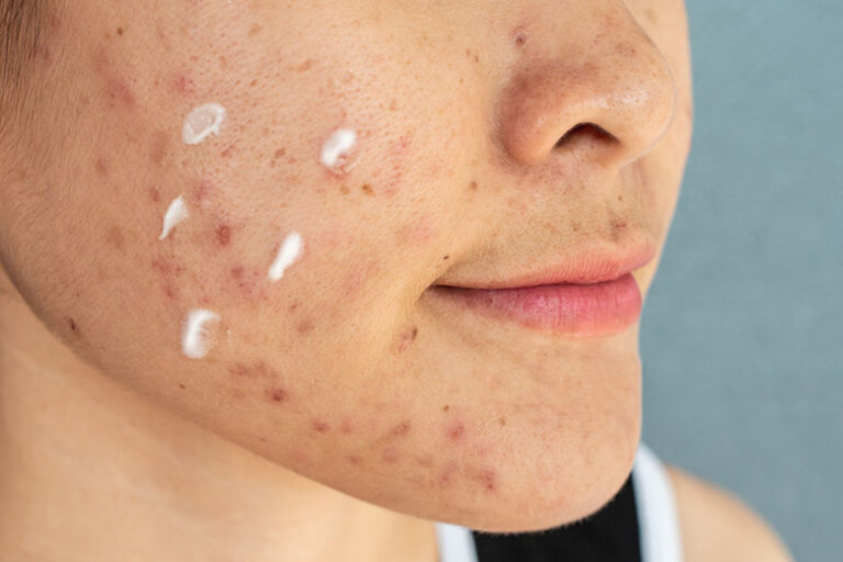 Nên bôi kem trị mụn trước hay sau serum?
