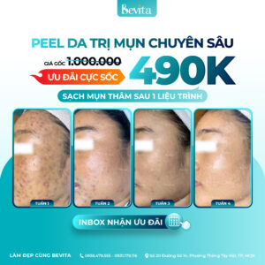Bevita Peeling – Peel Da Trị Mụn 490K/Buổi, Giải Pháp Cho Làn Da Sạch Mụn – Mịn Màng