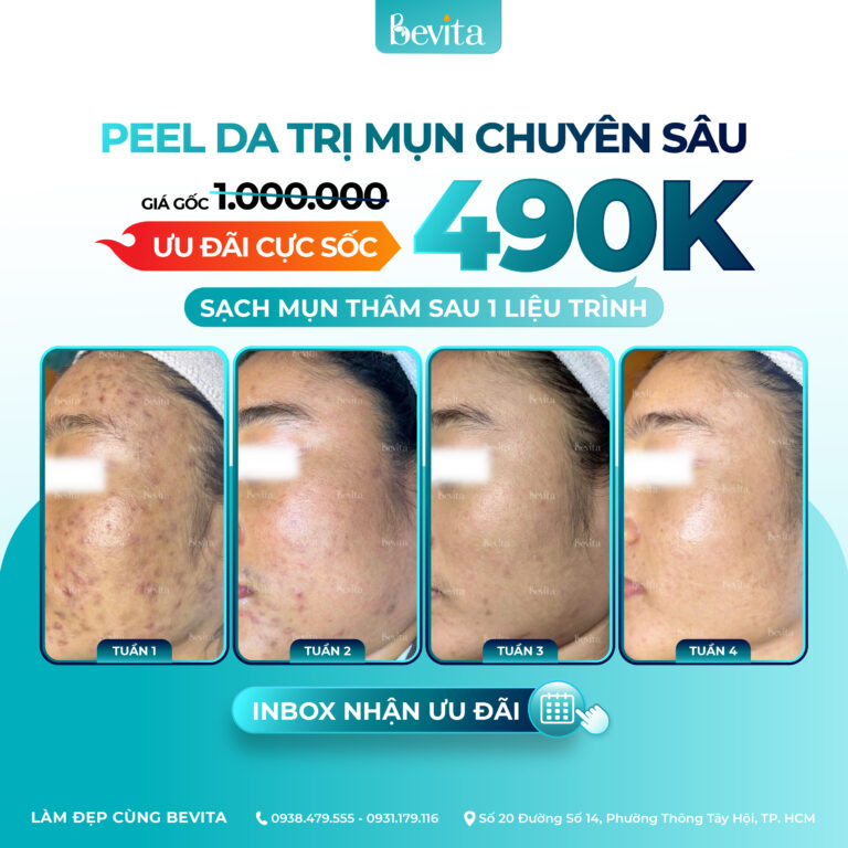 Bevita Peeling – Peel Da Trị Mụn 490K/Buổi, Giải Pháp Cho Làn Da Sạch Mụn – Mịn Màng